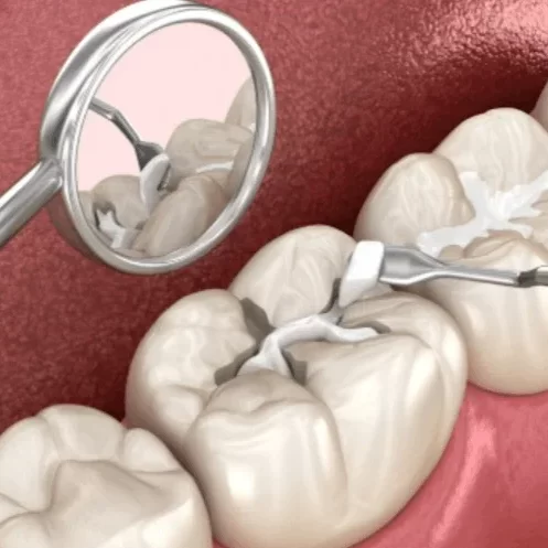tooth-filling-chennai